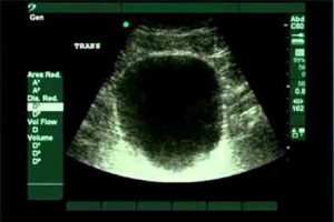 An ultrasound image of a healthy bladder.